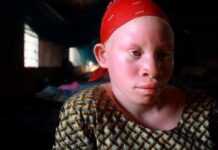Mettre fin à la persécution albinos en Afrique