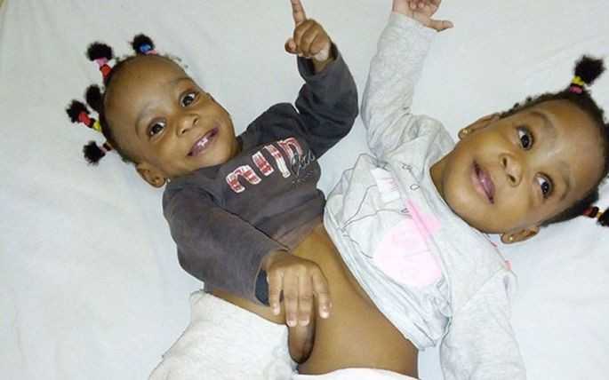 Cameroun Deux Petites Siamoises Operees A L Hopital Mere Enfant En France