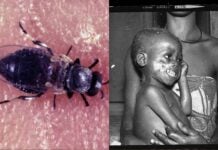 Onchocercose : la mouche noire (Simulium damnosum), vecteur du parasite, et un enfant souffrant de lésions cutanées causées par la maladie.