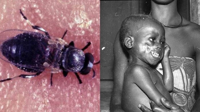 Onchocercose : la mouche noire (Simulium damnosum), vecteur du parasite, et un enfant souffrant de lésions cutanées causées par la maladie.